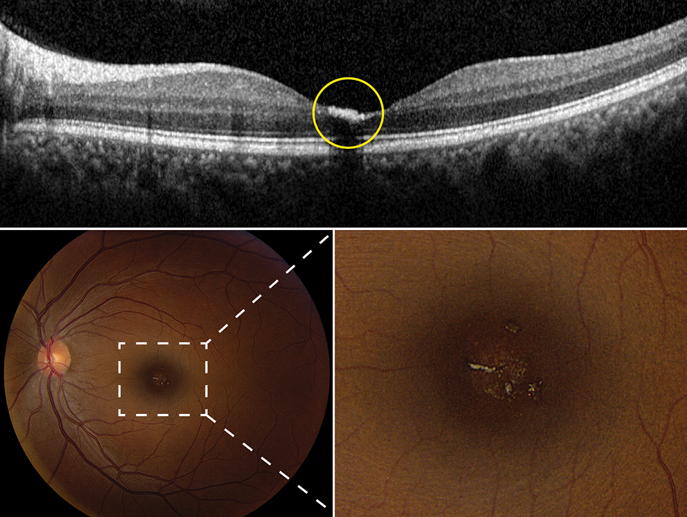 tamoxifen retinopathy